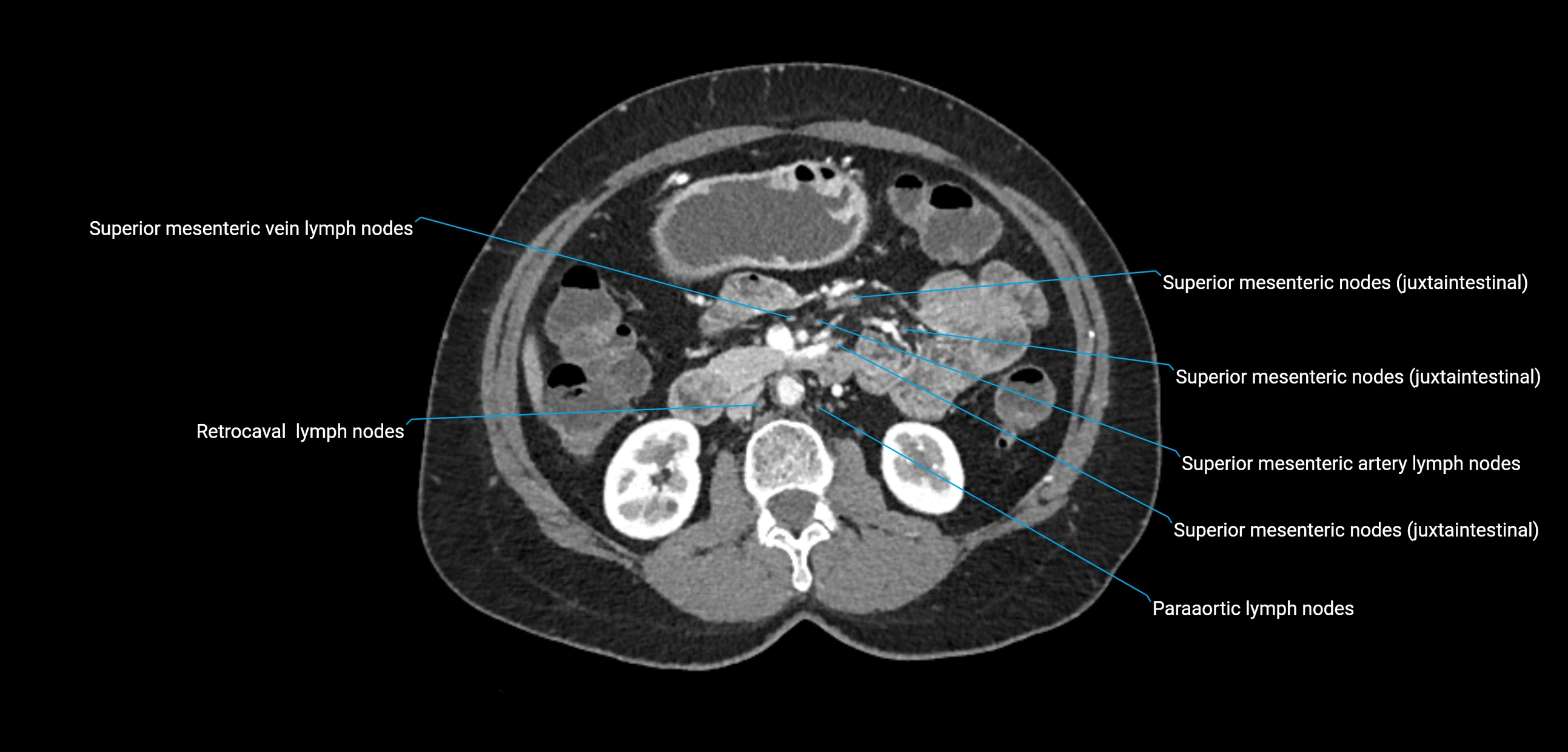 CT ct abdominal lymph nodes  axial cross sectional anatomy  enchanced radiology image -img-00002-00195.webp